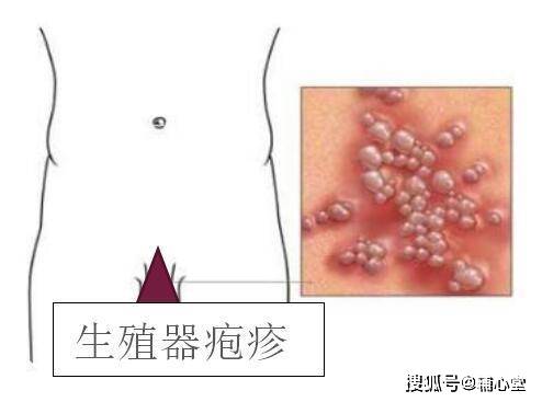 生殖疱疹最新研究探索，守护健康之路，揭秘未知领域