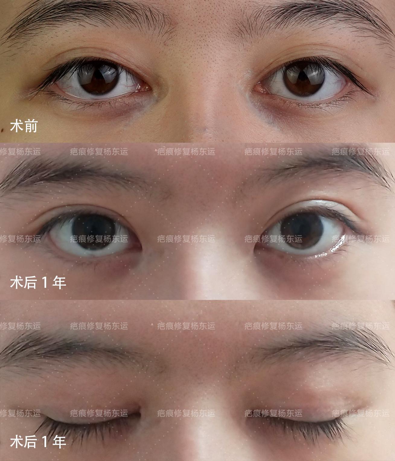 探索最新双眼皮流行趋势，开启美丽新篇章